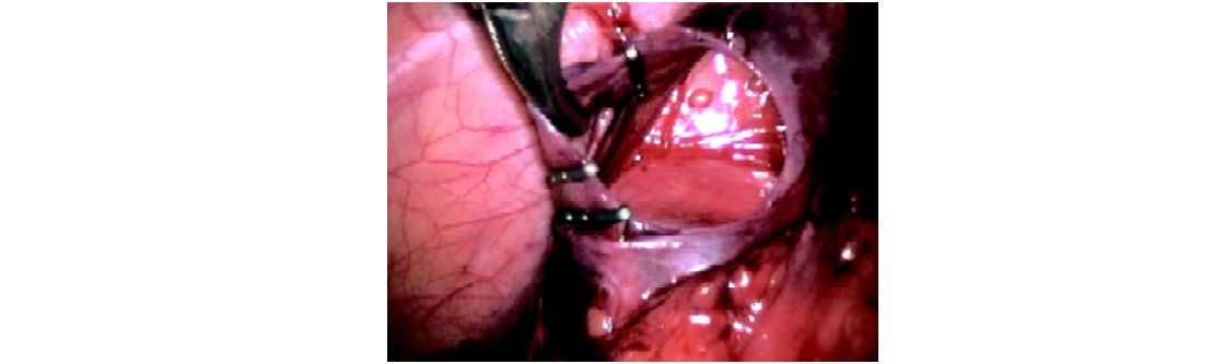 Clips applied around spermatic vein
