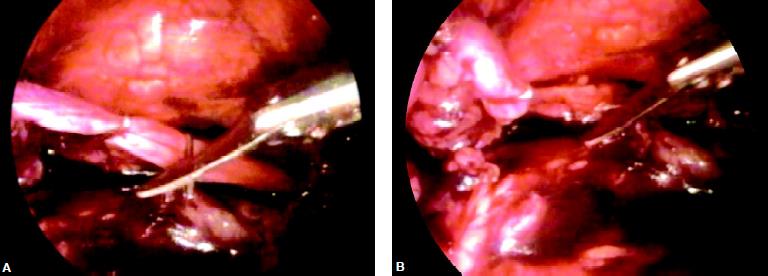 Two clips are applied over ureter and cut in between