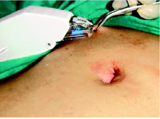 Closure of skin wound by skin stapler.