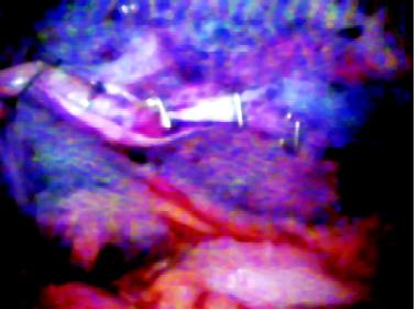 Closure of peritoneum