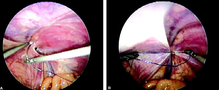 Closure of defect with intracorporeal suturing in pediatric age