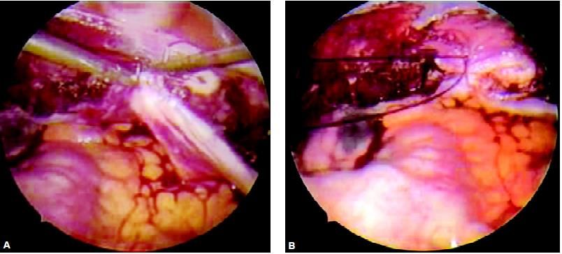 Closure of vault by extracorporeal knot