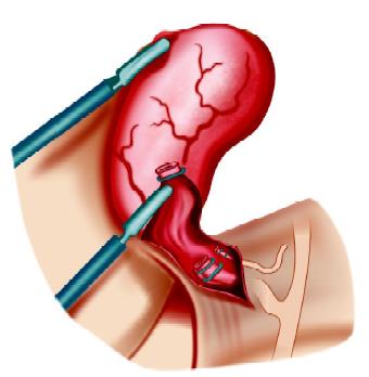 Clip-on cystic duct and artery