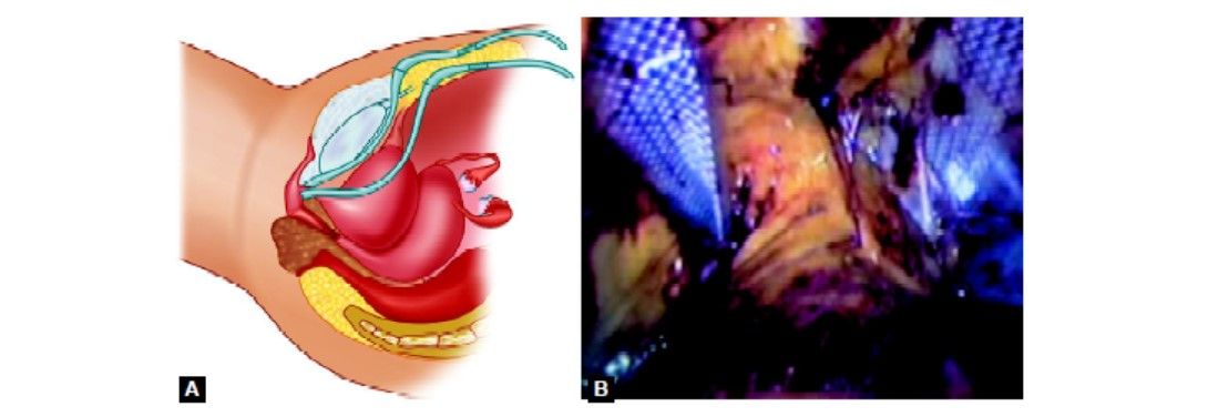 Completed application of tape with a laparoscopic view