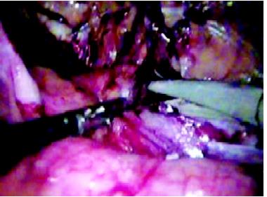Creation of preperitoneal space