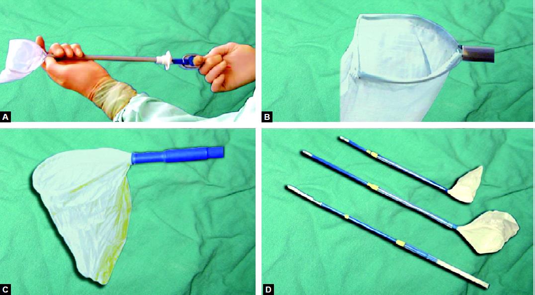 An Alternative Technique in Laparoscopic Cholecystectomies: Removal Without  a Specimen Bag