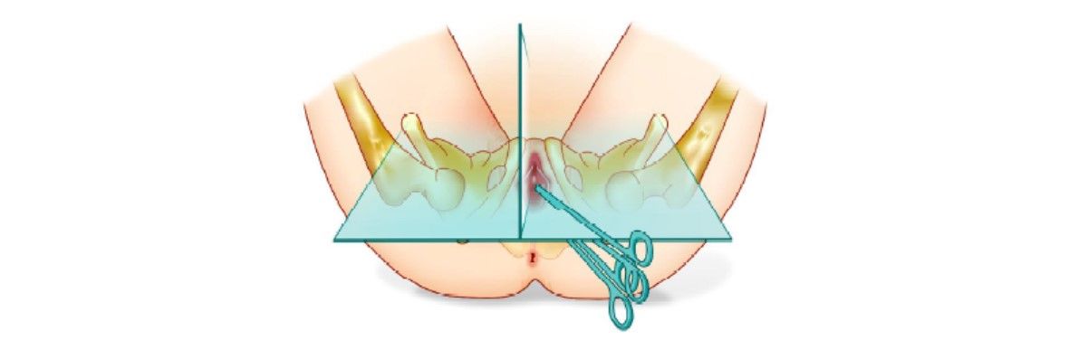  Dissect to the obturator membrane and perforate obturator membrane
