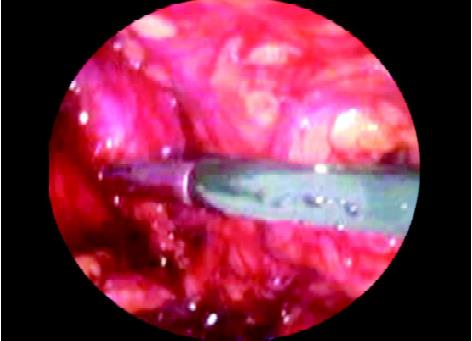 Dissection of preperitoneal space