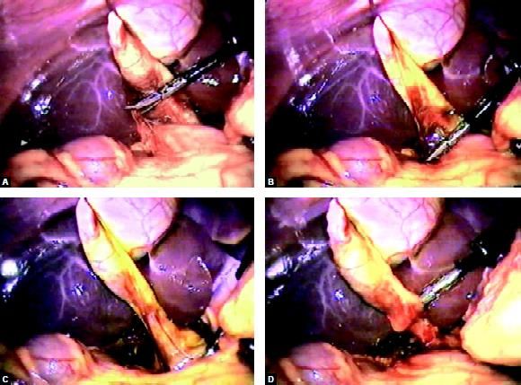 Dissection of cystic pedicle is performed by Maryland