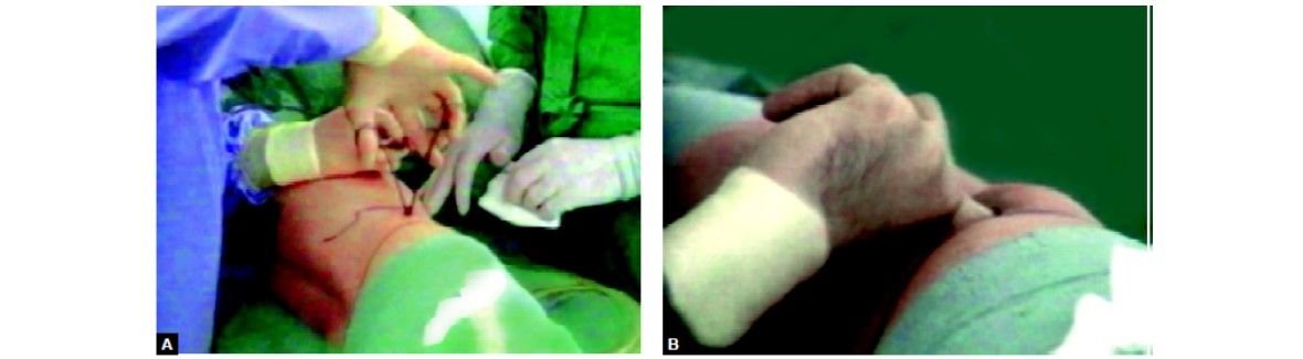 Finger dissection of retroperitoneal space