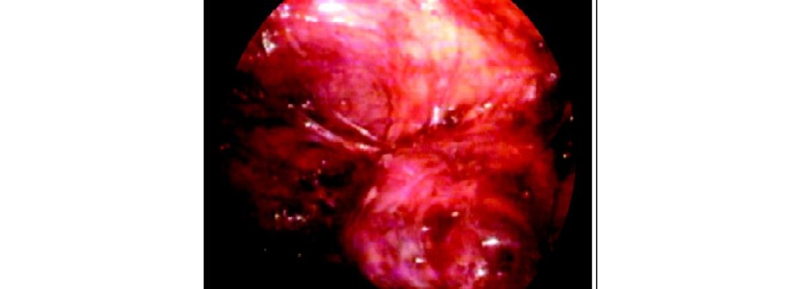 Posterior dissection of left kidney