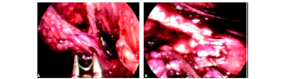 Dissection of hilum of kidney and application of clips before cutting