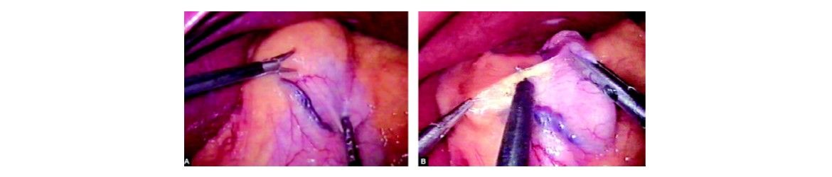 Lesser curvature a site chosen to start dissection
