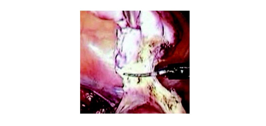 Dissection at the level of infundibulopelvic ligament