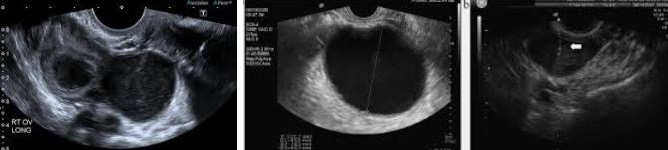Laparoscopic Endometrioma