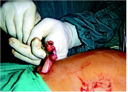 Extraction of gallbladder by gentle push from outside