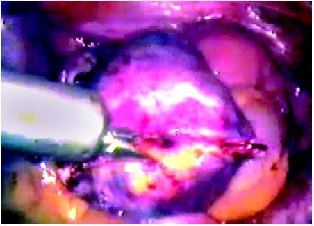 Extraction of Ovary