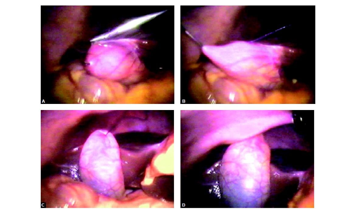 Fundus is retracted up with the help of needle and thread passed through intercostals space under vision