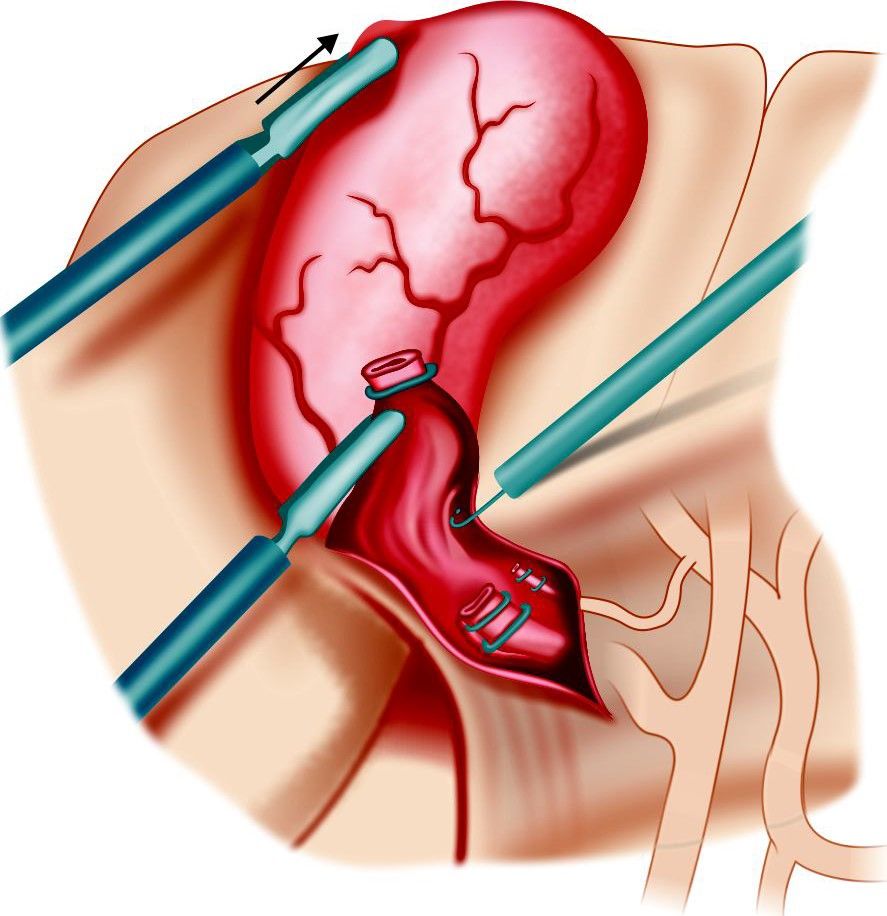 Separation of gallbladder from gallbladder (GB) bed