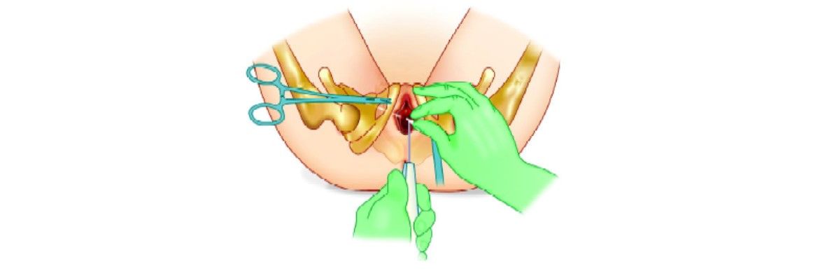Grasp tip of plastic tube then retract helical passer by reverse rotation