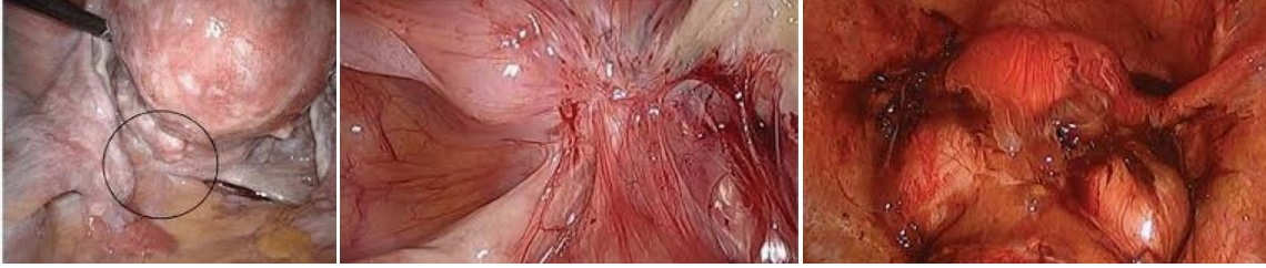 Genitourinary Endometriosis