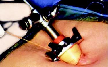 Hasson's cannula in proper position