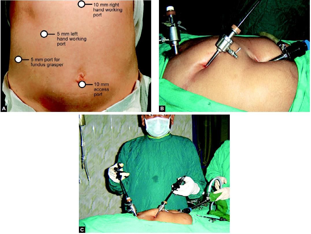(A) Ideal port position for laparoscopic cholecystectomy; (B and C) Port position of cholecystectomy