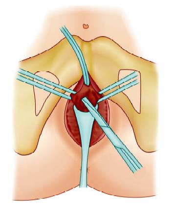Abdominal and vaginal incision for tension-free vaginal type (TVT) Via use of the Foley catheter and the rigid catheter guide, the urethra and bladder are moved 