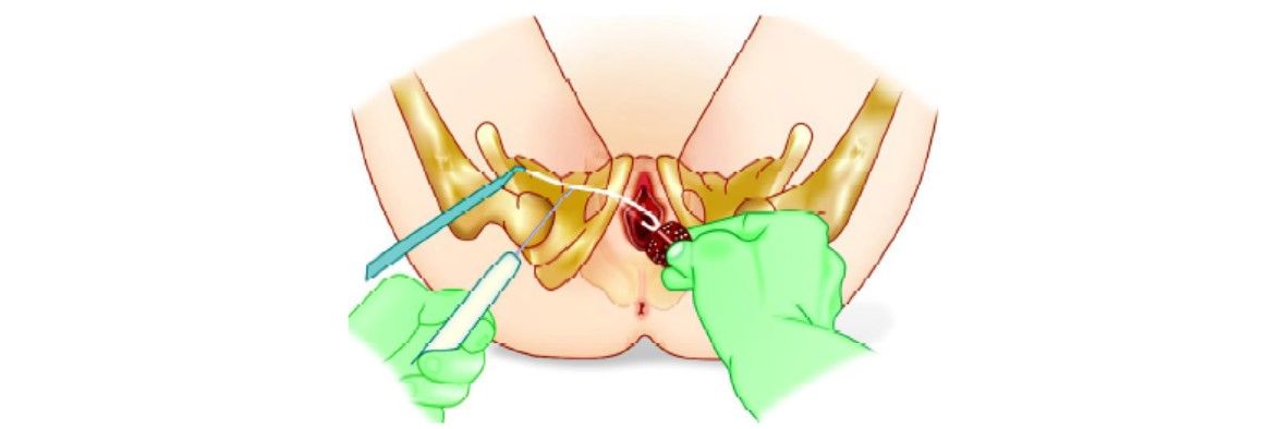 Insert winged guide and helical passer and then remove winged guide