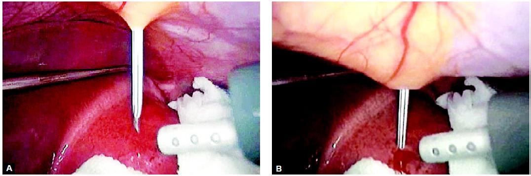 Instillation of hypertonic saline inside the cyst though percutaneous spinal needle