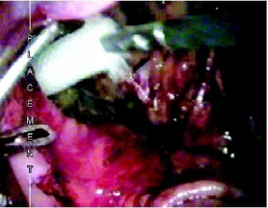 Introduction of mesh in preperitoneal space