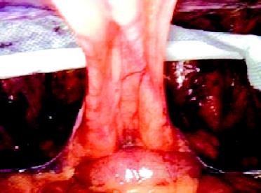  Introduction of mesh for bilateral hernia