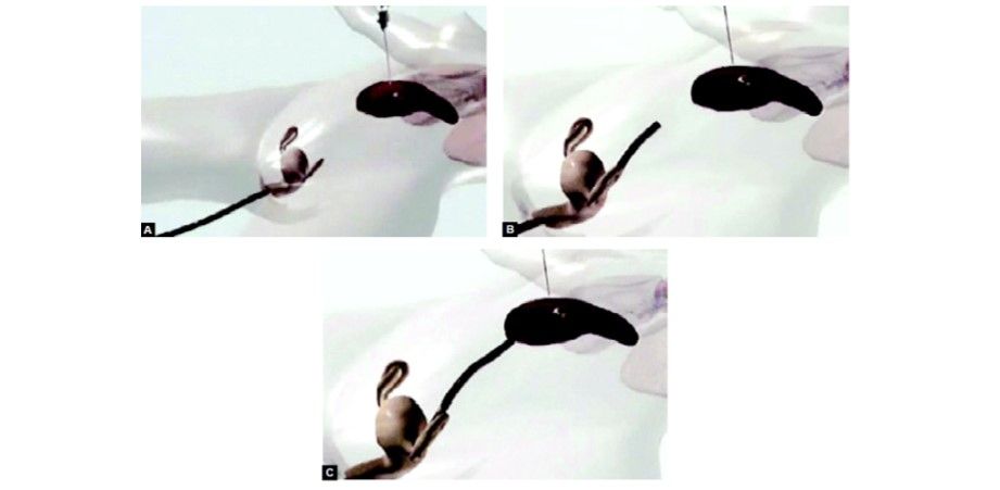 Introduction of operative endoscope through the vaginal orifice