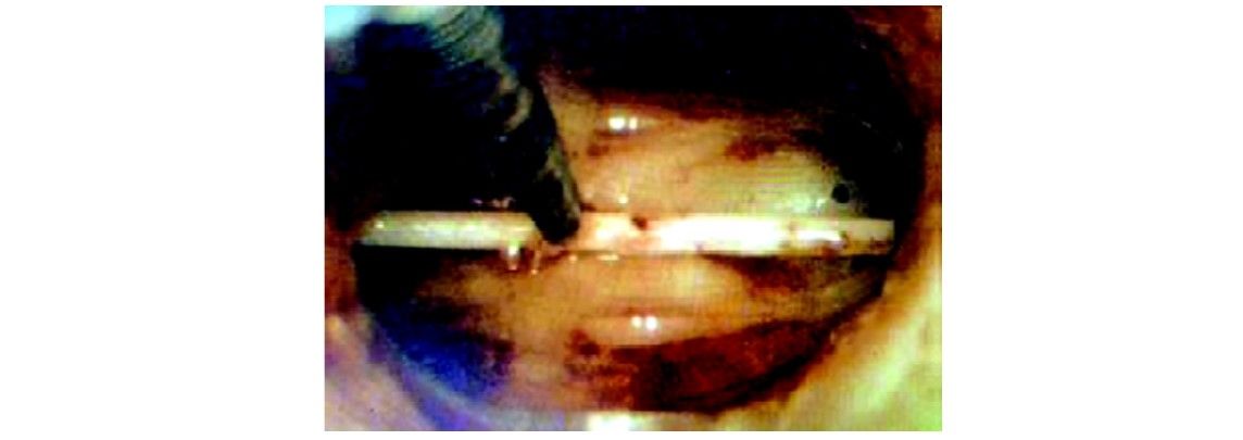 Forgotten IUD