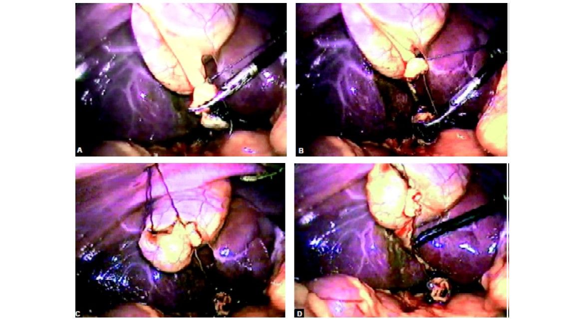  The extracorporeal knot of cystic duct is used to pull the neck up and to expose bed of the gallbladder