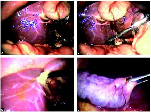 Any leak should be sucked and gallbladder is separated with the help of hook