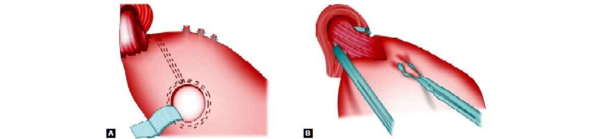 Laparoscopic vertical banded gastroplasty (A and B)
