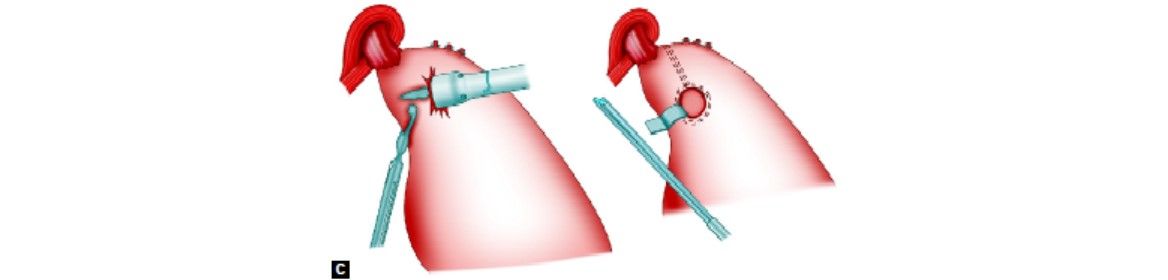Laparoscopic vertical banded gastroplasty (C)