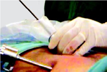 Introduction of mesh