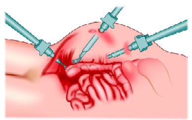 Mobilization of the cecum and right colon