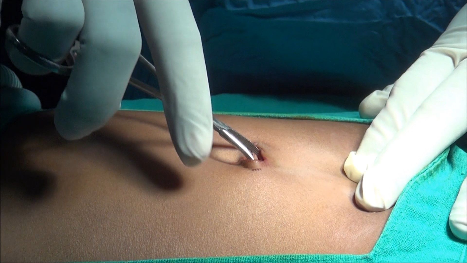 Insufflated Laparoscopic Model - PulseMDM