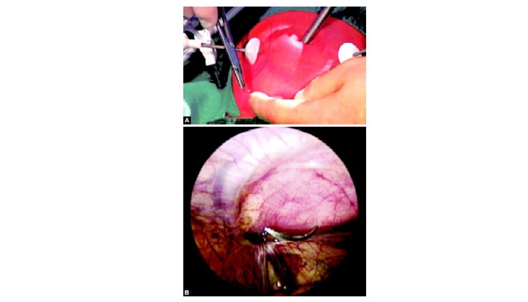 Needle should be introduced percutaneously in the pediatric age group