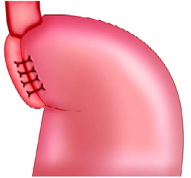  Nissen fundoplication (NF)