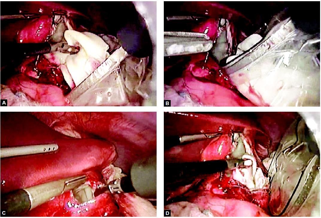 Opening of the cystic wall and extraction of germinal layer