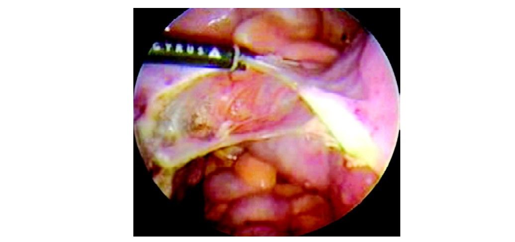 Opening of anterior and posterior leaf broad ligament