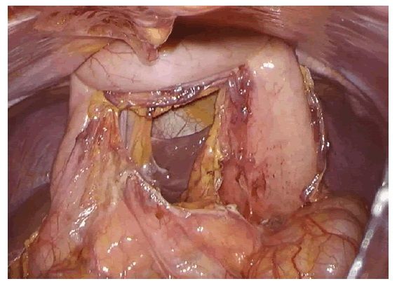Laparoscopic Pancreatic Surgery