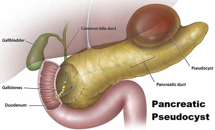 Laparoscopic Management of Pancreatic Pseudocyst
