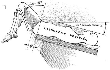 Patient position in Gynecological Laparoscopy