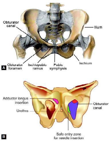 Pelvic anatomy demonstrating obturator foramen