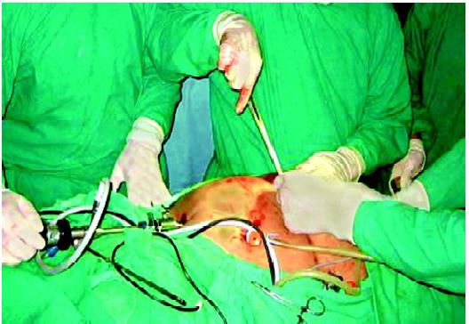 Proper closure of port greater than 10 mm is essential to prevent hernia